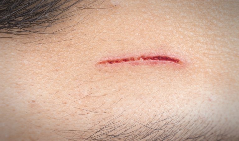 Treating Scrapes for Infections